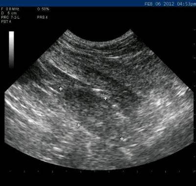 Examining his prostate using a rectal ultrasound probe, the prostate is seen spilling over the pelvic inlet into the abdominal cavity. Note the many white irregularities (representing mineralization) throughout the tissue.