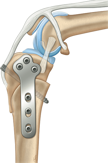Cora-based Leveling Osteotomy: My Two Cents on (CBLO) Repair