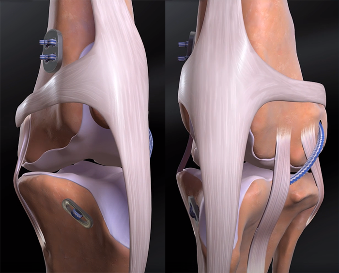 CCL Tears TightRope Repair