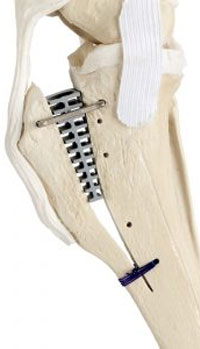 Tibial Tuberosity Advancement: TTA-2