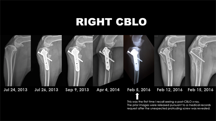 CBLO Surgery Complications: Lightning Bolt's Knee Injury and Surgery Disaster - radiographs